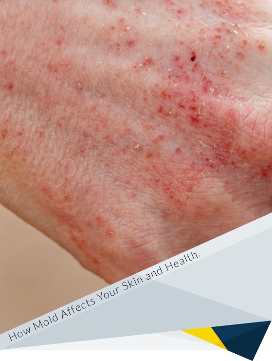 Skin Reactions to Mold: From Rashes to Irritation