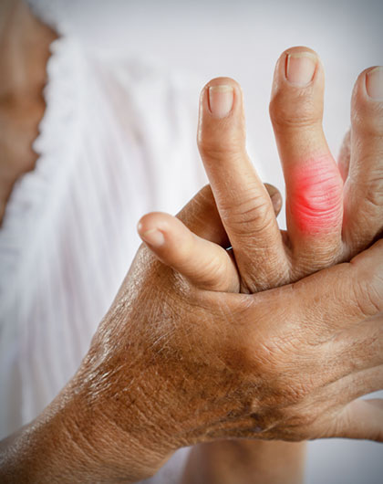 Arthritis Caused by Mold Exposure