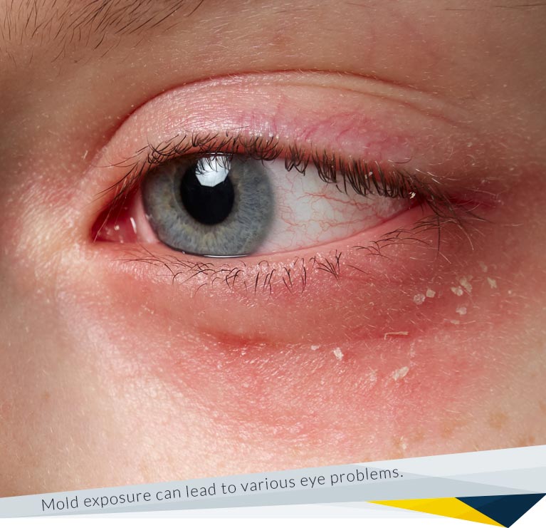 Eye Problems Due to Mold Exposure