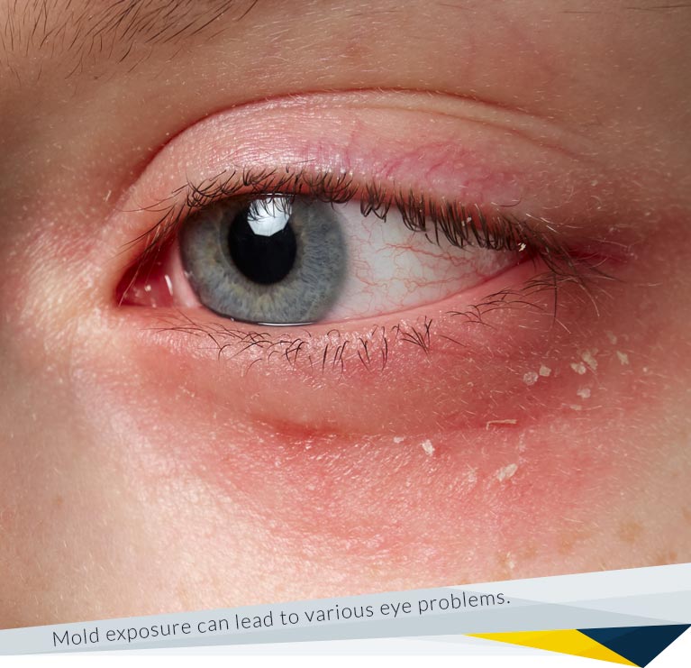 Eye Problems Due to Mold Exposure
