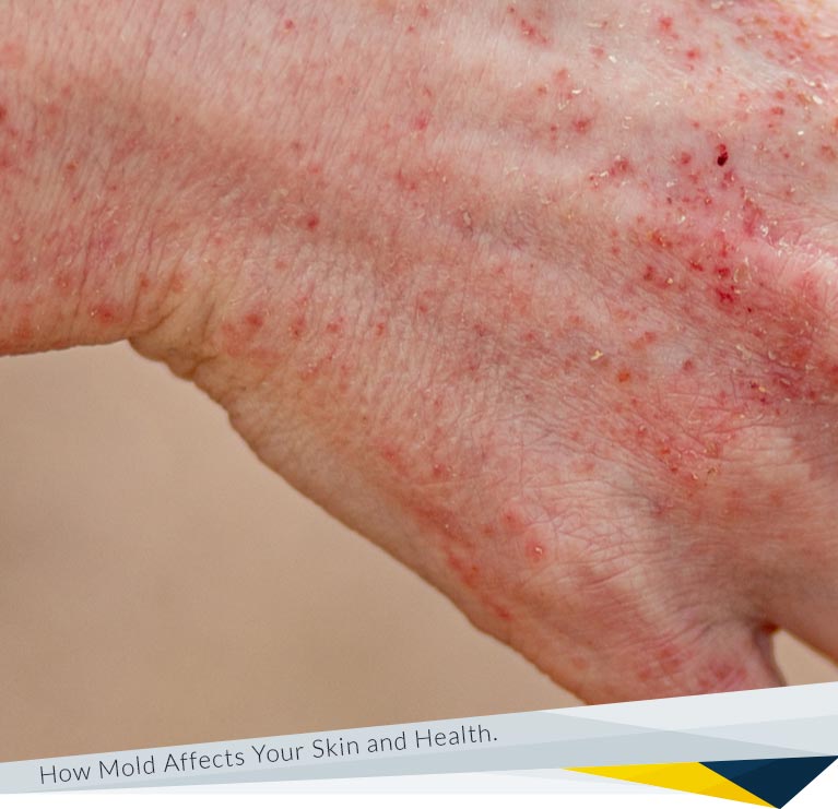 Skin Reactions to Mold: From Rashes to Irritation